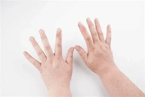 Swelling in the Limbs