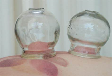 Cupping therapy