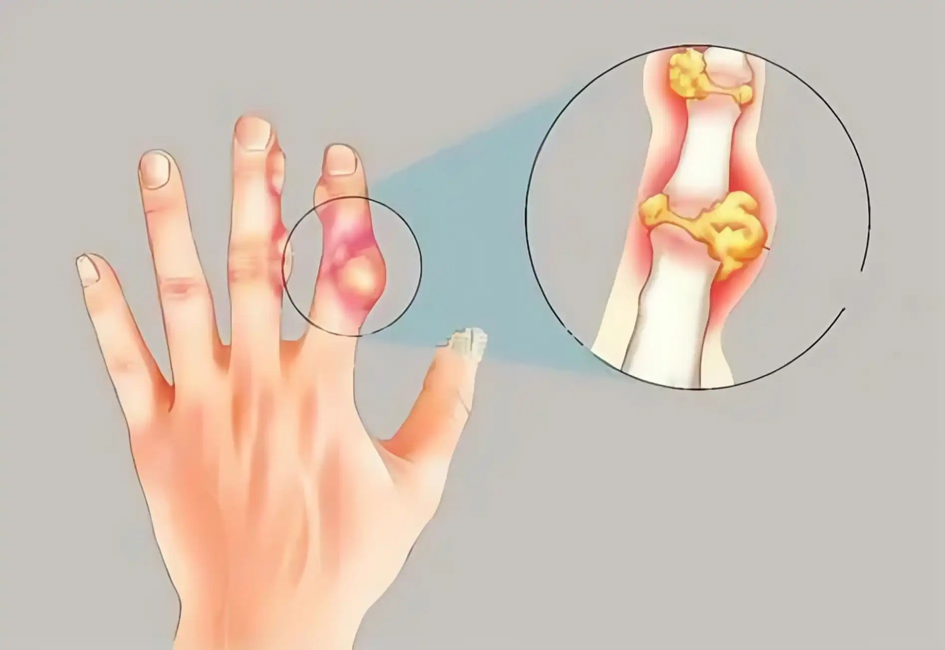 Symptoms of gout