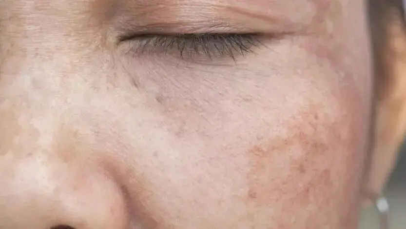 The fundamental reason for dull skin - melanin The fundamental reason for dull skin - melanin