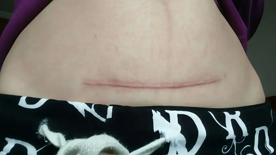 Cesarean section scar