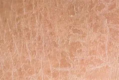 dry skin